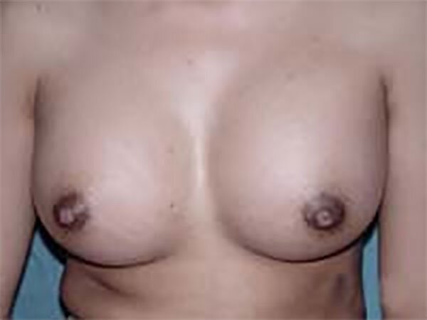 breast-augmentation-after-img-CAPS-2022