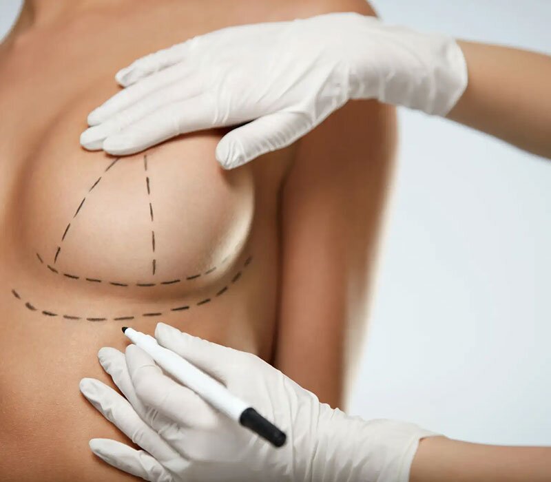 Breast Lift Mastopexy Surgery in Delhi